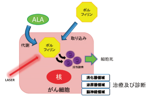 図1：ALA はポルフィリンとしてがん細胞に蓄積する。 これにレーザーを当てると細胞傷害性の高い活性 酸素が発生する。