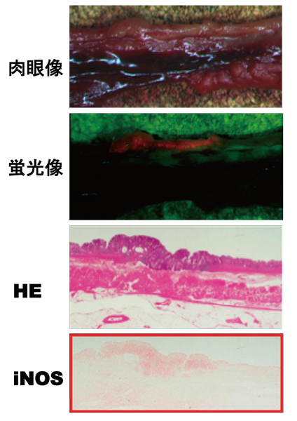 図2：がん手術検体の組織像（赤枠は組織 免疫染色像）蛍光像で赤色蛍光を放っ ている部分と活性酸素種を産生する iNOS の局在が一致している。赤色蛍 光部ががん部位である事はHE 染色か ら確認する事が出来る。